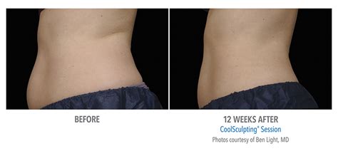 cool sculpting services in st. louis|Best Coolsculpting near me in St. Louis, MO .